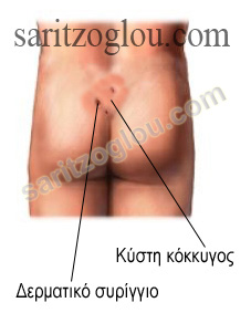 κύστη κόκκυγος