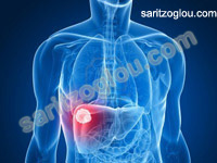 ηπατικές μεταστάσεις