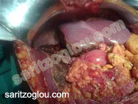 ηπατικές μεταστάσεις