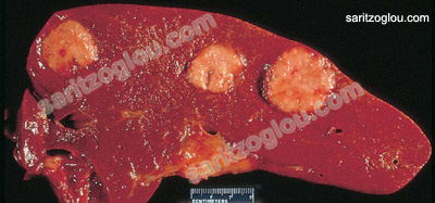 ηπατικές μεταστάσεις