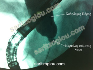 Καρκίνος φύματος Vater