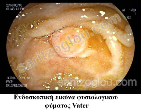 Καρκίνος φύματος Vater