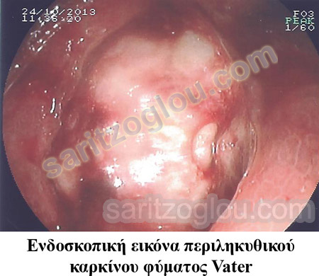 Καρκίνος φύματος Vater