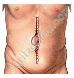 μετεγχειρητική κήλη