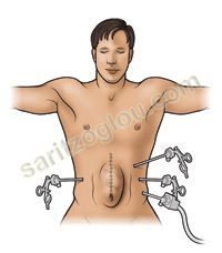 μετεγχειρητική κήλη
