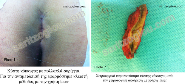 κύστη κόκκυγος