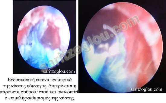 ενδοσκοπική εξάχνωση