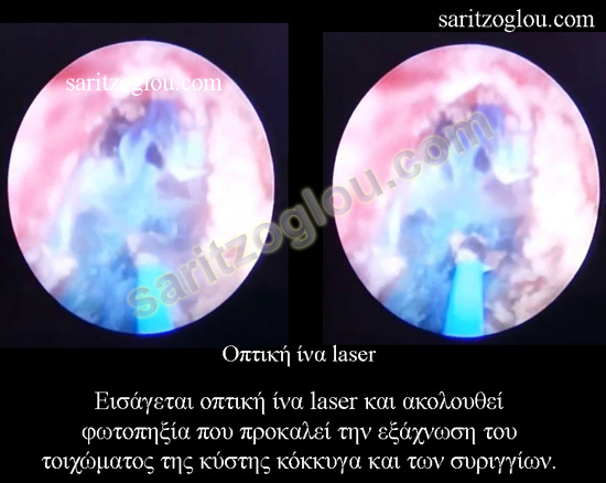 κύστη κόκκυγος