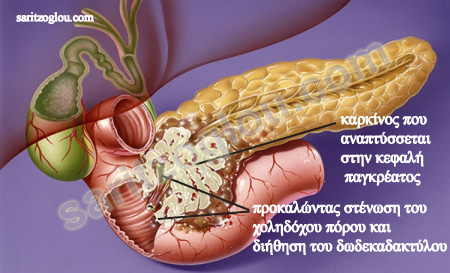 καρκίνος παγκρέατος