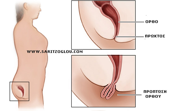 πρόπτωση ορθού