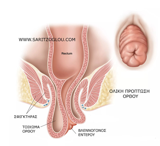 πρόπτωση ορθού