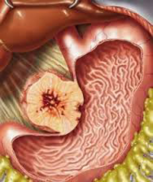 στρωματικοί όγκοι