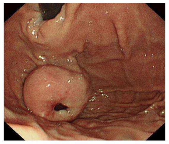 στρωματικοί όγκοι