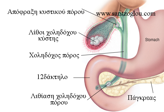 πέτρες στην χολή