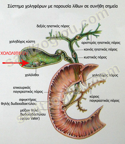 πέτρες στην χολή