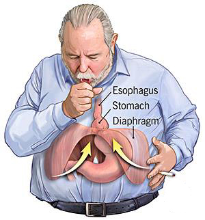 χρόνιος βήχας