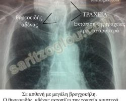 Εικόνες βρογχοκήλης θυρεοειδούς αδένα Σε απλή ακτινογραφίας θώρακος αναγνωρίζεται αριστερή εκτόπιση της τραχείας λόγω μεγάλης διόγκωσης του αριστερού λοβού του θυρεοειδούς συνεπεία μεγάλης βρογχοκήλης.