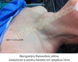 Εικόνες βρογχοκήλης θυρεοειδούς αδένα Ασθενής πάσχουσα από μεγάλη βρογχοκήλη θυρεοειδούς αδένα. Διακρίνεται η μεγάλη διάταση του τραχήλου λόγω του αυξημένου μεγέθους του αδένα.