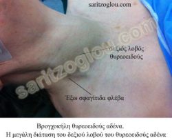 Εικόνες βρογχοκήλης θυρεοειδούς αδένα Βρογχοκήλη θυρεοειδούς αδένα. Η μεγάλη διάταση του δεξιού λοβού προκαλεί εκτόπιση της έξω σφαγίτιδας φλέβας.
