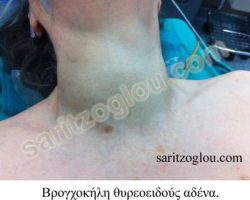Εικόνες βρογχοκήλης θυρεοειδούς αδένα Διακρίνεται η μεγάλη διόγκωση του θυρεοειδούς αδένα και κυρίως του δεξιού λοβού σε ασθενή που πάσχει από βρογχοκήλη.