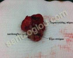 Περιεδρικό συρίγγιο. Χειρουργικό παρασκεύασμα στο οποίο παρουσιάζεται το έξω στόμιο του συριγγίου και τμήμα του σηραγγώδη πόρου.