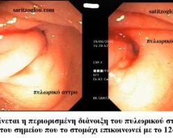 Απόφραξη δωδεκαδακτύλου λόγω καρκίνου κεφαλής παγκρέατος. Τοποθέτηση stent δωδεκαδακτύλου. Ενδοσκοπική εικόνα πυλωρικού στομίου. Η παρούσα περίπτωση αφορά διηθητική στένωση της πρώτης μοίρας του δωδεκαδακτύλου αμέσως μετά το πυλωρικό στόμιο λόγω ανεγχείρητου καρκίνου κεφαλής παγκρέατος.