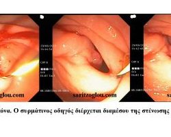 Απόφραξη δωδεκαδακτύλου λόγω καρκίνου κεφαλής παγκρέατος. Τοποθέτηση stent δωδεκαδακτύλου. Διαμέσου της στένωσης του δωδεκαδακτύλου, διέρχεται συρμάτινος οδηγός και ακολούθως καθετήρας διαστολών η θέση του οποίου επιβεβαιώνεται με την χρήση της ακτινοσκόπησης. Ακολουθούν προοδευτικές διαστολές της στενεμένης περιοχής του 12δακτύλου με καθετήρα τύπου μπαλόνι.