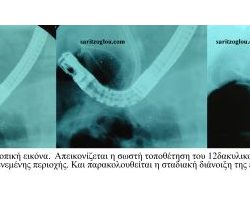 Απόφραξη δωδεκαδακτύλου λόγω καρκίνου κεφαλής παγκρέατος. Τοποθέτηση stent δωδεκαδακτύλου. Ακτινοσκοπική εικόνα δωδεκαδακτυλικού stent. Απεικονίζεται η επιτυχής τοποθέτηση του stent στην διηθητικά στενεμένη περιοχή του δωδεκαδακτύλου, καθώς και η ομαλή διαστολή της ενδοπρόθεσης.