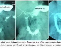 Απόφραξη δωδεκαδακτύλου λόγω καρκίνου κεφαλής παγκρέατος. Τοποθέτηση stent δωδεκαδακτύλου. Ακτινοσκοπική εικόνα διάβασης δωδεκαδακτύλου. Απεικονίζεται η θέση, η διάνοιξη της στενεμένης περιοχής και η ομαλή διέλευση του υγρού από το στομάχι προς το δωδεκαδάκτυλο και το υπόλοιπο έντερο.