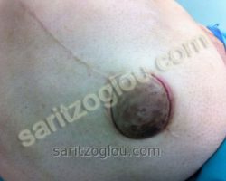 Εικόνες διαφόρων κηλών – Ειλεός από περισφιγμένη κήλη Περισφιγμένη μη ανατασσόμενη ομφαλοκήλη που οδήγησε σε ειλεό λόγω στραγγαλισμού του εντέρου.