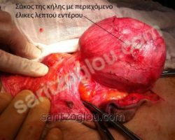 Εικόνες διαφόρων κηλών – Ειλεός από περισφιγμένη κήλη Φαίνεται ο σάκος της κήλης μέσα στον οποίο έχει εγκλωβιστεί το λεπτό έντερο με αποτέλεσμα τον ειλεό.