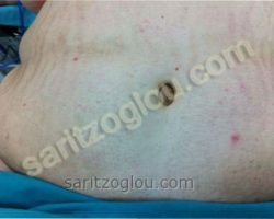 Εικόνες διαφόρων κηλών – Ειλεός από περισφιγμένη κήλη Περίπτωση ομφαλοκήλης. Φαίνονται οι ισχαιμικές αλλοιώσεις το δέρματος του ομφαλού.