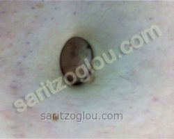 Εικόνες διαφόρων κηλών – Ειλεός από περισφιγμένη κήλη Περισφιγμένη μη ανατασσόμενη ομφαλοκήλη.