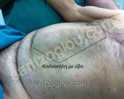Εικόνες διαφόρων κηλών – Ειλεός από περισφιγμένη κήλη Μεγάλη κοιλιοκήλη με χαρακτηριστικό ύβο.