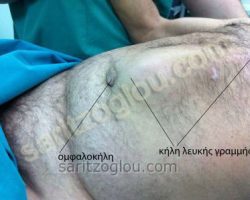 Εικόνες διαφόρων κηλών – Ειλεός από περισφιγμένη κήλη Κοιλιοκήλη και ομφαλοκήλη στο ίδιο ασθενή.