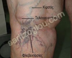 Εικόνες κιρσοί κάτω άκρων – ευρυαγγείες – τελαγγειεκτασίες – φλεβεκτασίες – μείζονα σαφηνής φλέβα Κιρσοί , φλεβεκτασίες και τελαγγειεκτασίες στο κάτω άκρο του ίδιου ασθενούς ως αποτέλεσμα χρόνιων κιρσών των κάτω άκρων.