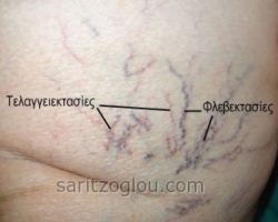 Εικόνες κιρσοί κάτω άκρων – ευρυαγγείες – τελαγγειεκτασίες – φλεβεκτασίες – μείζονα σαφηνής φλέβα Χαρακτηριστική εικόνα τελαγγειεκτασιών και φλεβεκτασιών.