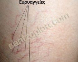 Εικόνες κιρσοί κάτω άκρων – ευρυαγγείες – τελαγγειεκτασίες – φλεβεκτασίες – μείζονα σαφηνής φλέβα Εικόνα χαρακτηριστικών ευρυαγγειών.