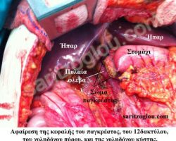 Επέμβαση Whipple Τα ανατομικά στοιχεία μετά την αφαίρεση της κεφαλής του παγκρέατος, του 12δακτύλου, της χοληδόχου κύστης και του χοληδόχου πόρου.
