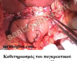 Επέμβαση Whipple Καθετηριασμός του παγκρεατικού πόρου και καθετήρα 6fr.