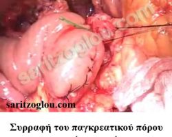 Επέμβαση Whipple Συρραφή του παγκρεατικού πόρου με την οπή του εντέρου.