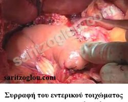 Επέμβαση Whipple Συρραφή του παγκρεατικού τοιχώματος με το εντερικό τοίχωμα.