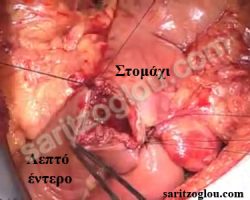 Επέμβαση Whipple Αναστόμωση του στομάχου με την νήστιδα.