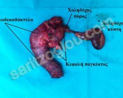 Επέμβαση Whipple Χειρουργικό παρασκεύασμα το οποίο περιλαμβάνει, το 12δεκαδάτυλο, την κεφαλή του παγκρέατος, την χοληδόχο κύστη και τον χοληδόχο πόρο.