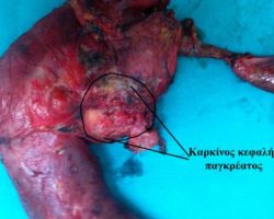 Επέμβαση Whipple Ο καρκίνος της κεφαλής του παγκρέατος στο χειρουργικό παρασκεύασμα.