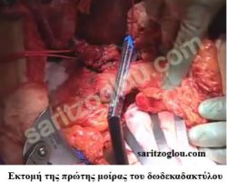 Επέμβαση Whipple Εκτομής της πρώτης μοίρας του δωδεκαδακτύλου με αυτόματο κοπτο-συρραπτικό μηχάνημα και διατήρηση του πυλωρικού σφιγκτήρα.