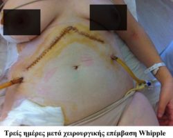 Επέμβαση Whipple Γυναίκα ασθενής τρείς ημέρες μετά χειρουργική επέμβαση Whipple.
