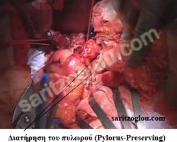 Επέμβαση Whipple Διατήρηση του πυλωρού(Pylorus-Preserving)