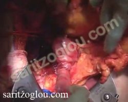 Επέμβαση Whipple Η 3η και 4η μοίρα του δωδεκαδακτύλου διέρχεται μεταξύ των άνω μεσεντέριων αγγείων και της αορτής.