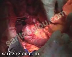 Επέμβαση Whipple Η 3η και 4η μοίρα του δωδεκαδακτύλου διέρχεται μεταξύ των άνω μεσεντέριων αγγείων και της αορτής.